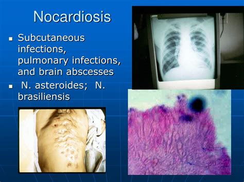 PPT - Actinomyces & Nocardia PowerPoint Presentation, free download ...