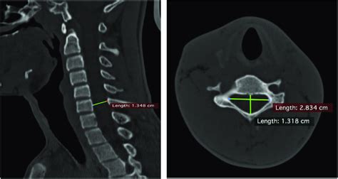 Measuring Sagittal And Transverse Diameters On Ct Scan The Point And Download Scientific