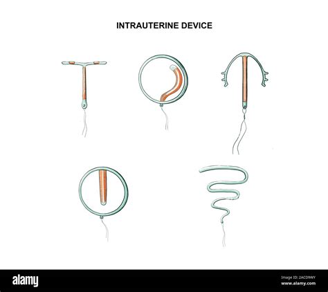 Illustration Of The Intrauterine Device Stock Photo Alamy