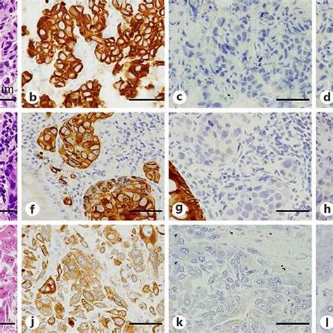 A He Staining Of The Radical Cystectomy Specimen By Gross Examination