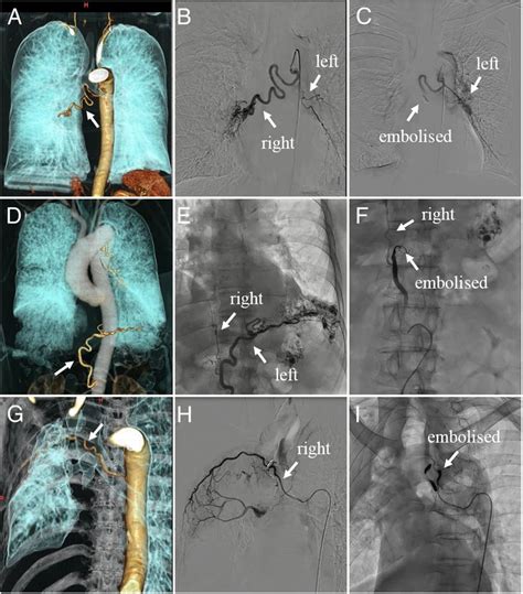 Efficacy And Safety Of Super Selective Bronchial Artery Coil Embolisation For Haemoptysis A