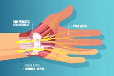 Carpal Tunnel Release Decompression Surgery Midwest Orthopaedics