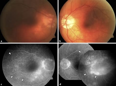 Fundus Photographs Of The Patient At The Second Onset Of Vkh Disease In