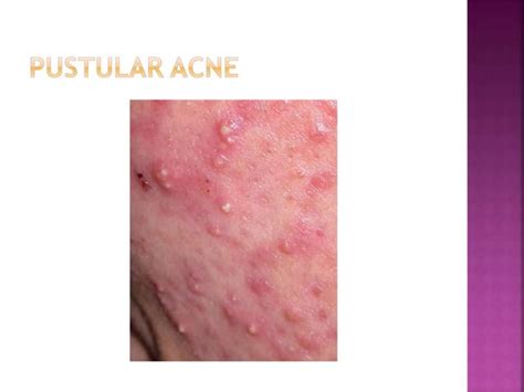 Treatment Of Acne Vulgaris In General Practice Ppt