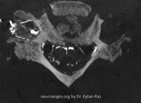 Cervical Spinal Dural Fistula