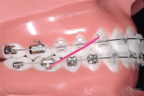 Free Nhs Braces Retainers And Nhs Orthodontic Treatments Purely