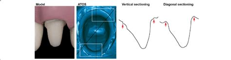 Buccal View Of Model With Partially Supra And Subgingival Preparation