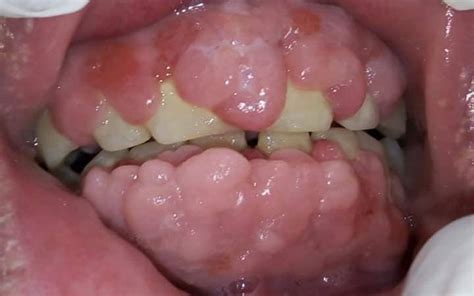 Gingivitis Histology