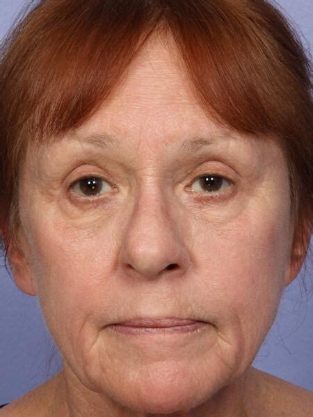 Laser Skin Resurfacing Gallery Before And After 79 Marina Medspa