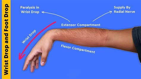 Foot Drop And Wrist Drop Part 2 Chart Tcml Youtube