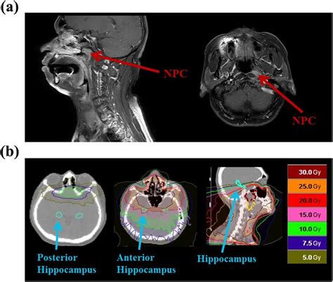 Dosimetric Distribution In Radiotherapy For Nasopharyngeal Carcinoma