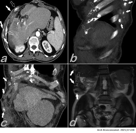 Metastases Of Alveolar Echinococcosis To The Skin Pleura Ribs And