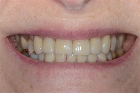 Fixed Prosthodontics And Restorative Dentistry Pacific Prosthodontics
