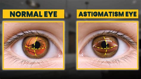 How To Manage And Treat Astigmatism In 2024 Eye Expert Advice Youtube