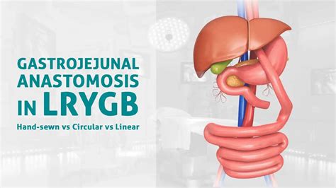 AIS Channel Gastrojejunal Anastomosis In LRYGB Hand Sewn Vs