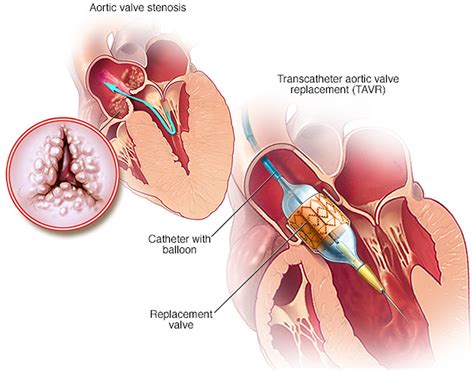 Aortic Valve Stenosis Causes Symptoms Life Expectancy Treatment