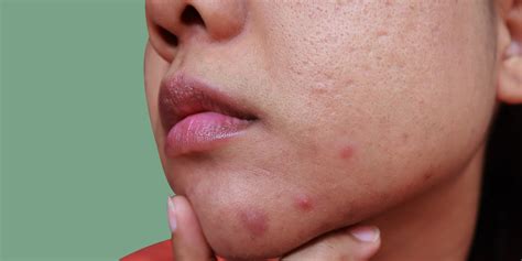 What Causes Chin Acne And How To Treat It According To Dermatologists