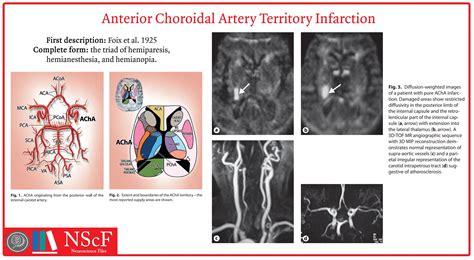 Posterior Choroidal Artery