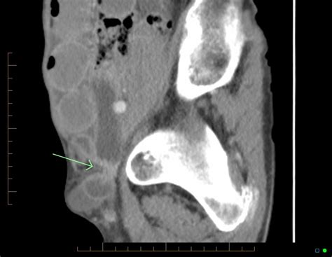 Femoral hernia CT - wikidoc