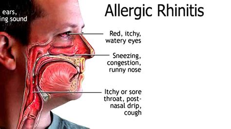 Allergic Rhinitis