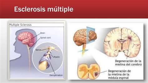 Esclerosis Múltiple Ppt