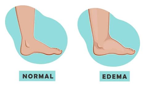 5 Causes Of Swelling In The Feet Rfeetfirstclinic