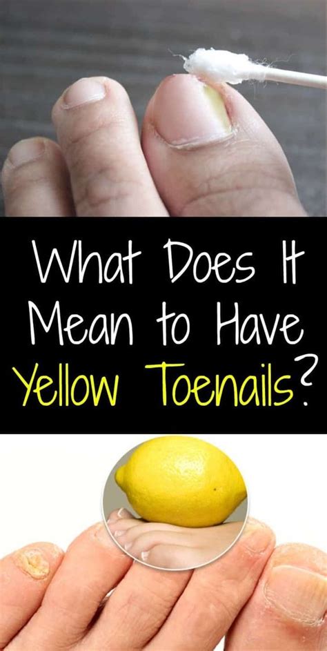 What Does It Mean To Have Yellow Toenails Treatment And Causes