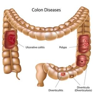 C Mo Comprender Los P Lipos Del Colon Y Su Tratamiento Dr Sergio C Zares