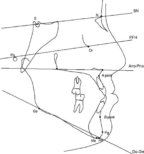 Cephalometric Reference Points Ans Pns Go Gn The Ratio Of The