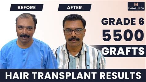 Sapphire Hair Transplant Results India 5500 Grafts Grade 6 Hamilton Baldness 8 Months