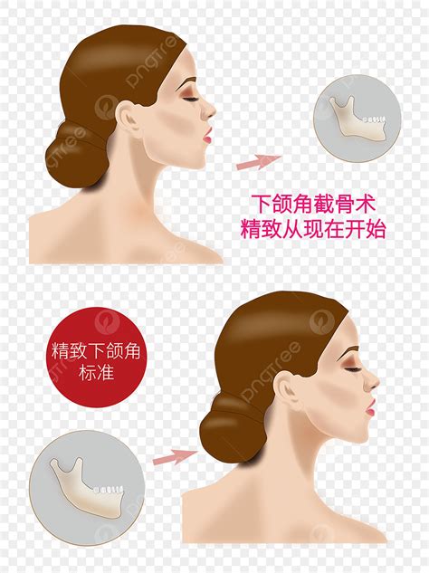 Angled Vector Art PNG, Hand Painted Mandibular Angle Osteotomy, Hand Painted, Decorative Pattern ...