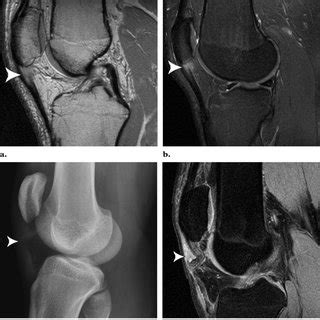 Sinding Larsen Johansson Syndrome A Radiograph Of A Year Old Boy