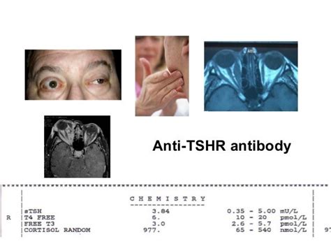 Pathophysiology Of Graves Orbitopathy