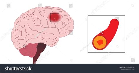 Brain Stroke Illustration Stroke Frontal Lobe Stock Illustration 1992445196 | Shutterstock