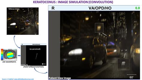 Visual disturbances in keratoconus - Defeat Keratoconus