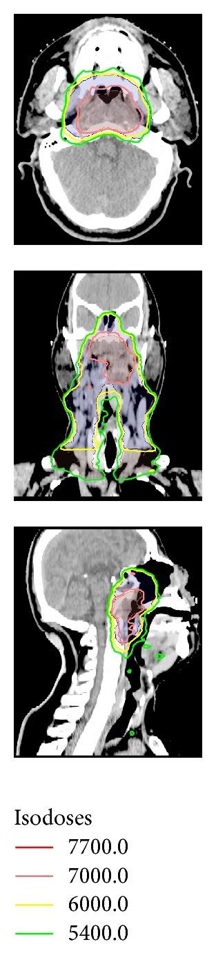 Dose Distributions On Axial Coronal And Sagittal Views For One