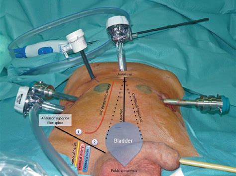 Surgical Anatomy Of The Bladder Springerlink