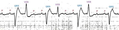 Killer Ecg Patterns • Litfl Medical Blog • Ecg Library