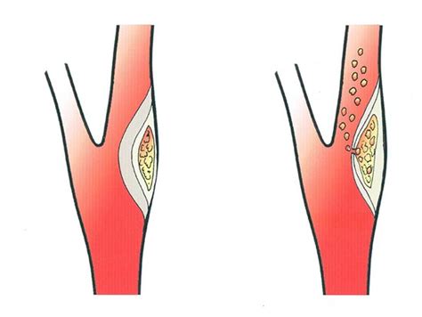 Carotid Artery Blockage. carotid artery blockage surgery, carotid ...