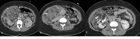 Figure From Selective Arterial Embolization Of Giant Renal