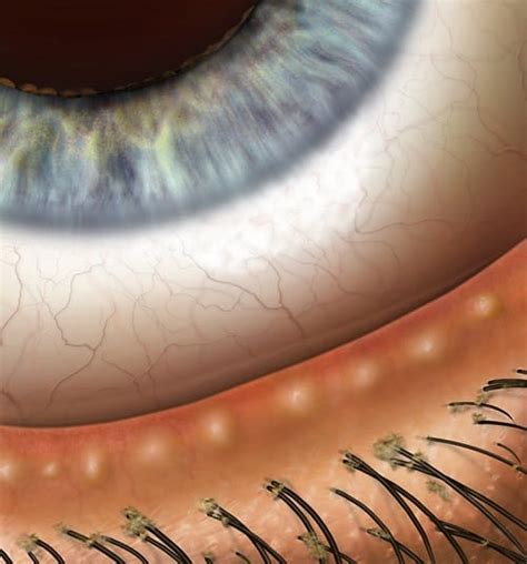 Blepharitis Eyelid Inflammation Seidenberg Protzko Eye Associates