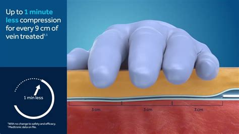 Medtronic S VenaSeal Closure System Product Animation YouTube