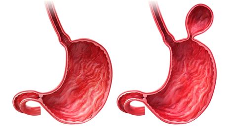 Hernia de hiato Qué es Causas Síntomas y Tratamientos