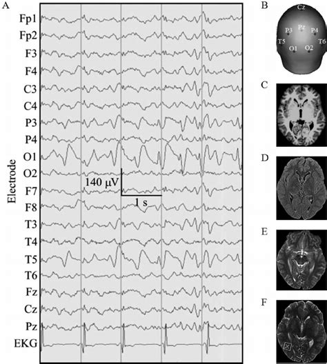 A Patient Interictal Electroencephalogram Eeg And Download