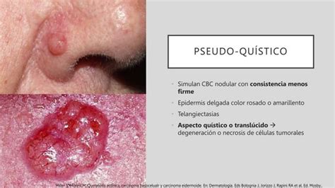 Carcinoma Basocelular Espinocelular Y Su Tratamiento Ppt