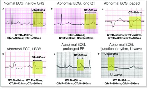 Qt Interval Cardioschool