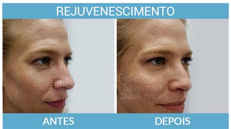 Rejuvenescimento A Laser De Co Entenda Como Funciona Cl Nica De Pele