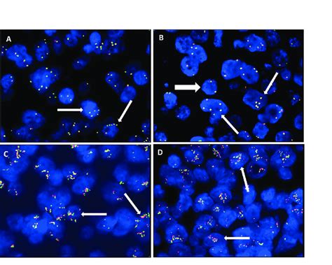 Numerical Aberrations Of MYC By Fluorescence In Situ Hybridization