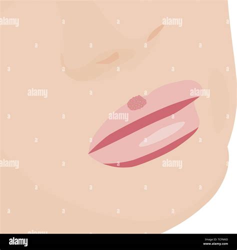 Blisters Because Of Cold Sores On Lips Vector Illustration Virus