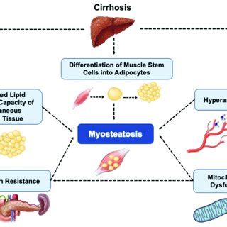 Summary Of Pathways Contributing To Myosteatosis In Cirrhosis